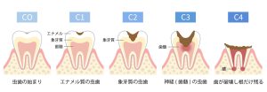 虫歯の進行