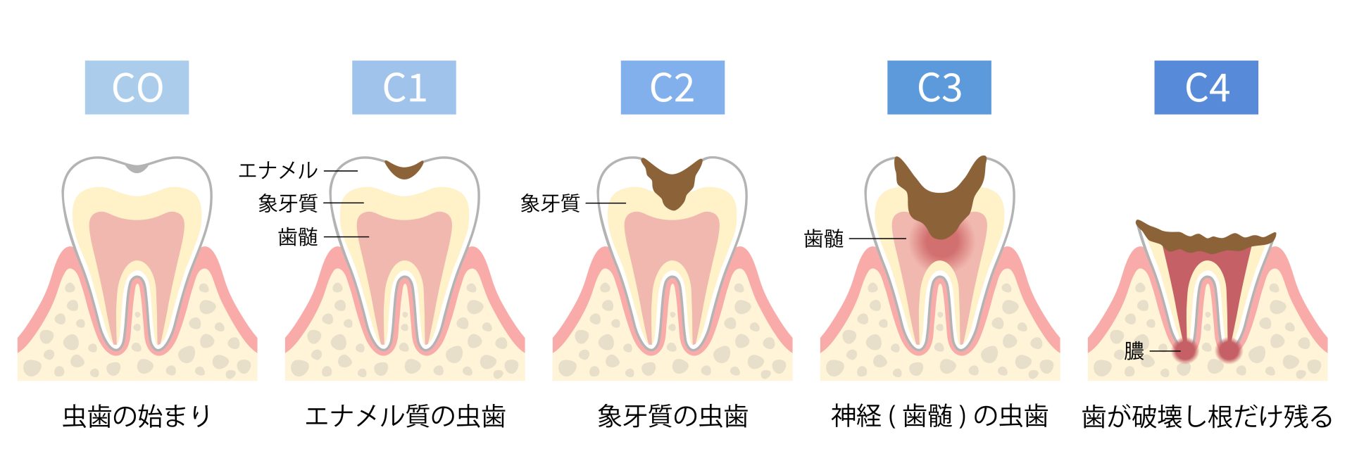虫歯の進行