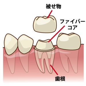 根管治療後の歯の構造