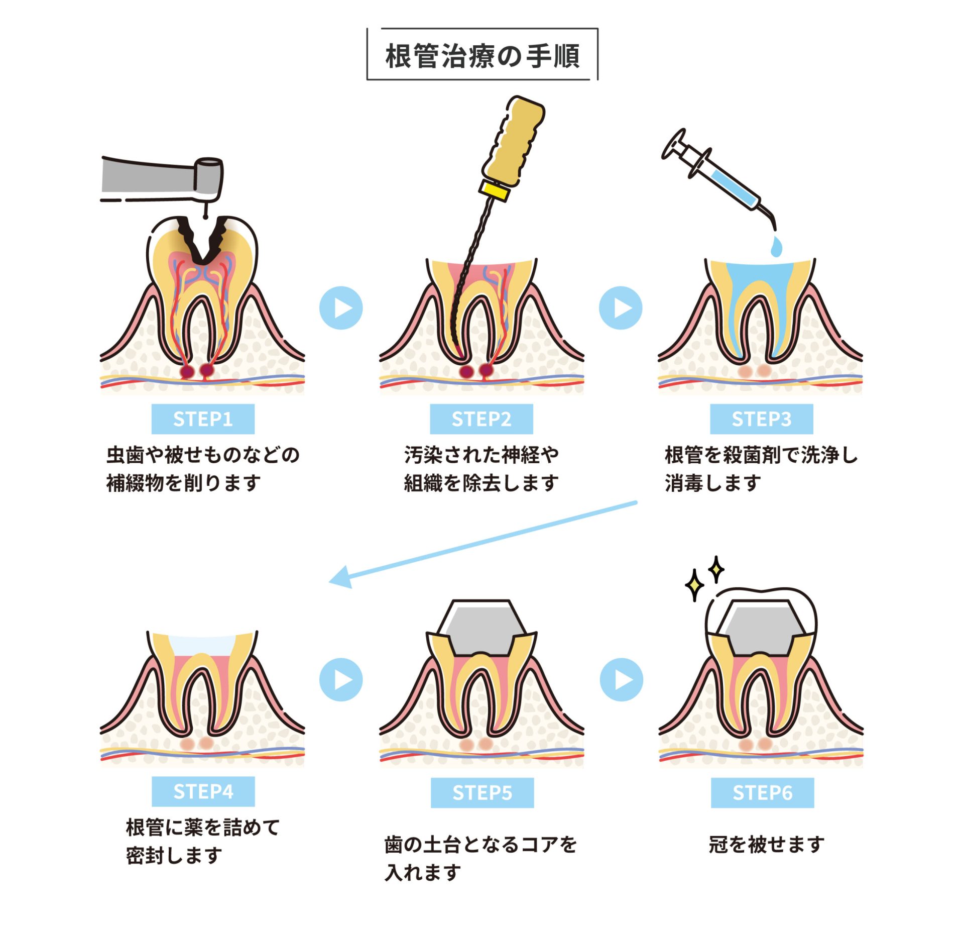 歯の神経治療にかかる時間は?回数と期間を解説 - 千葉で治療回数の少ない歯の神経治療(根管治療)