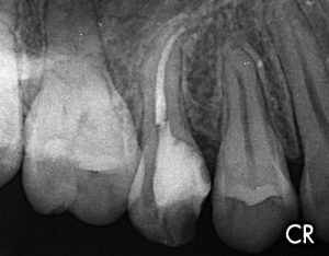 初回根管治療（抜髄）の根管充填後