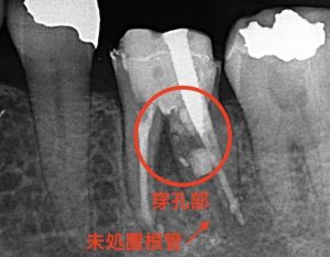 パーフォレーションリペア（穿孔部封鎖）の術前