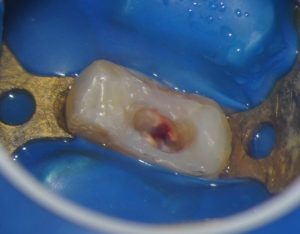 VPT（歯髄温存療法）の炎症を起こした神経