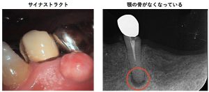 サイナストラクト／顎の骨がなくなっているレントゲン