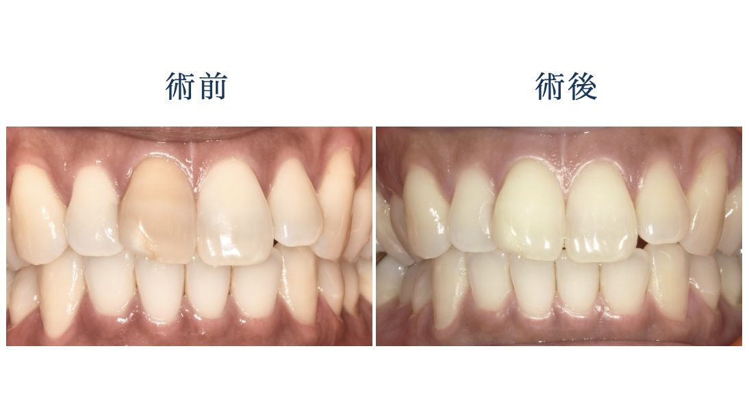館山市根管治療術前・術後