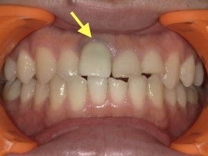 メタルタトゥー