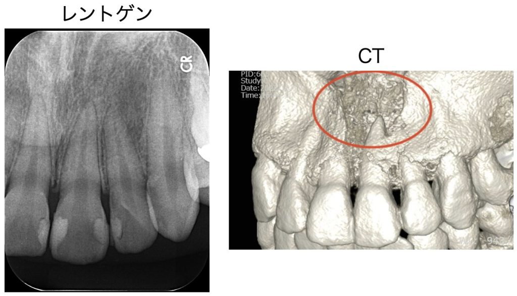 レントゲンとCT