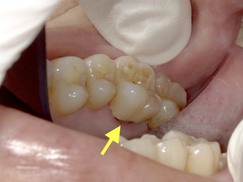 歯と歯茎の境目の虫歯