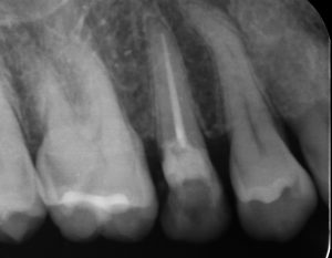 茂原市抜髄根管充填後