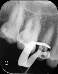茂原市抜髄治療中