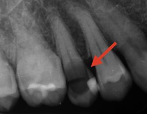 茂原市抜髄術前