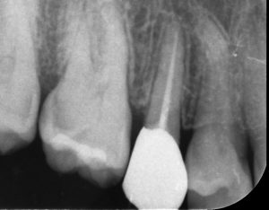 茂原市被せ物セット後