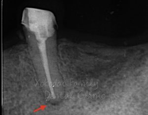 根管治療の術後5ヶ月のレントゲン