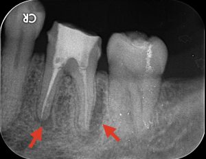 袖ケ浦感染根管治療術前