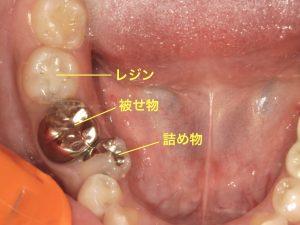 レジン・詰め物・被せ物